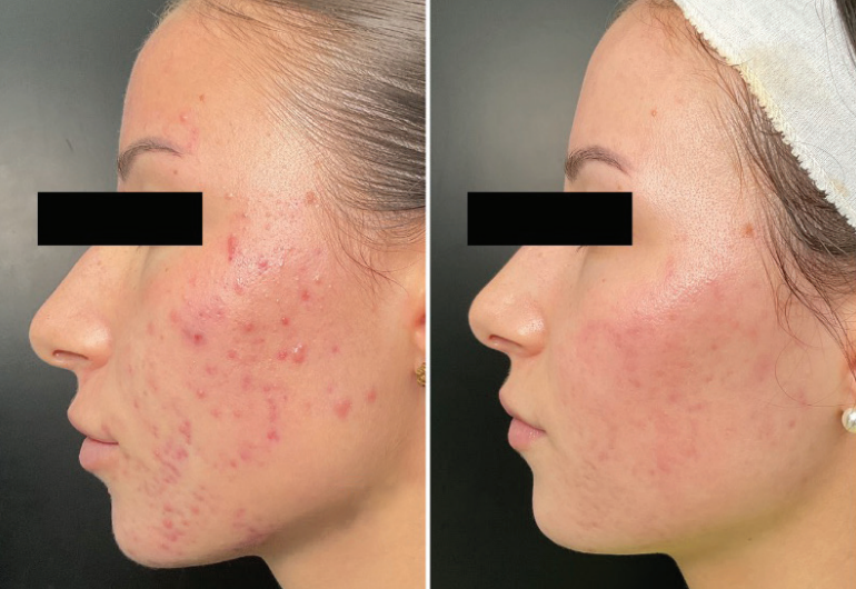 Before and after comparison of a persons face with acne using microneedling and salmon DNA.